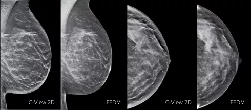 Images of breast x-ray