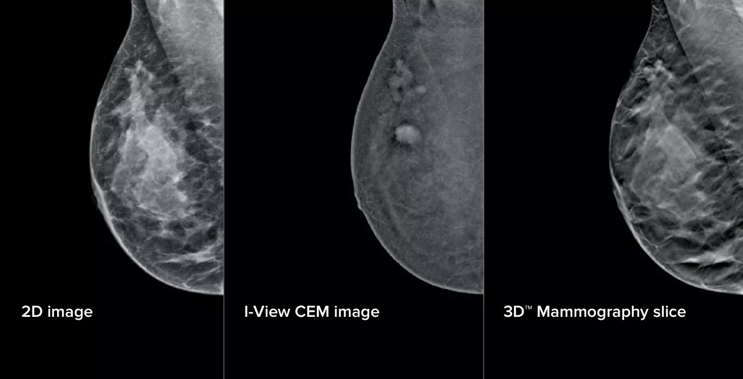 Breast Imaging Scans