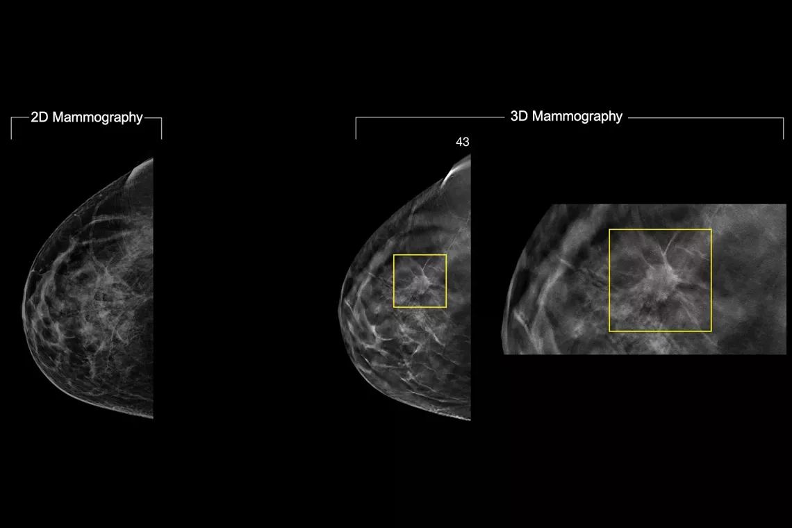 Scans of breast mammography